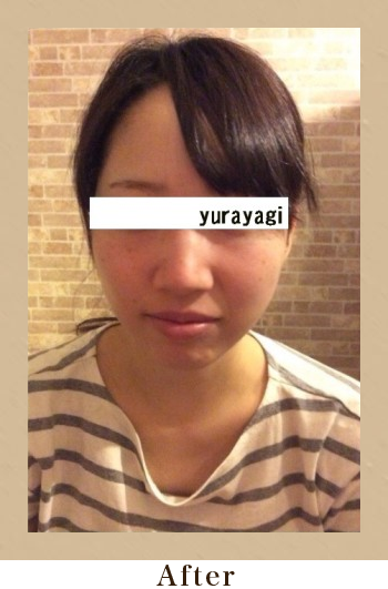 美筋小顔セラピーAfter画像01