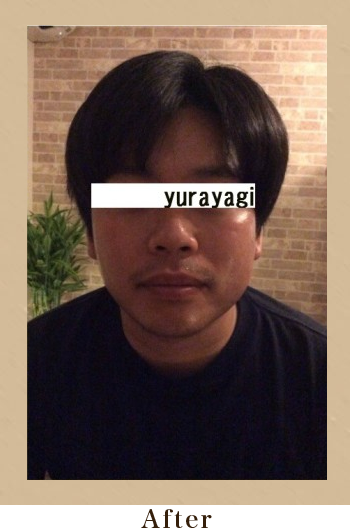 美筋小顔セラピーAfter画像03