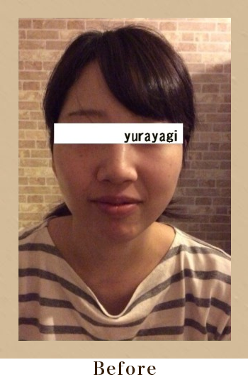 美筋小顔セラピーBefore画像01