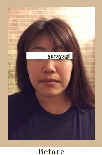 美筋小顔セラピーBefore画像03