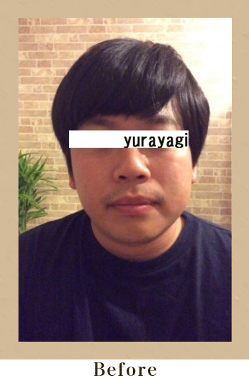 美筋小顔セラピーBefore画像03