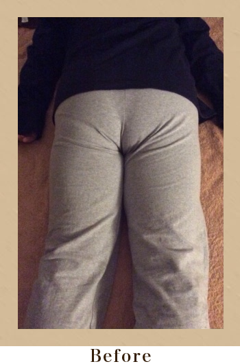 フーレセラピーBefore画像01