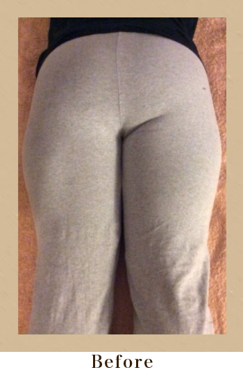 フーレセラピーBefore画像03