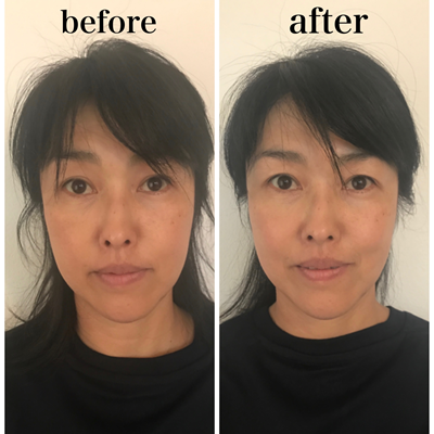 小顔マジックBefore画像03