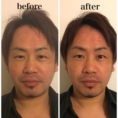 小顔マジックBefore画像05