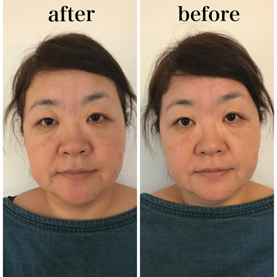 小顔マジックBefore画像07